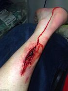 Σοκάρει η φωτογραφία με το τραυματισμένο πόδι του Άιρλαντ