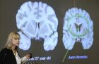 H Aν ΜακΚι, διευθύντρια του κέντρου έρευνας χρόνιων ασθενειών τραυματικής εγκεφαλοπάθειας του Boston University μιλά στους φοιτητές, το Νοέμβρη του 2017. Αριστερά είναι ο νορμάλ εγκέφαλος ενός 27χρονου και δεξιά του Χερνάντεζ.