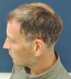 Άλλος άνθρωπος ο Κλάτενμπεργκ μετά την εμφύτευση μαλλιών