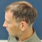 Ο Κλάτενμπεργκ το 2017- Credit: Medical Hair Restoration Clinic