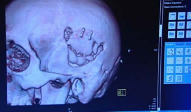 Η ακτινογραφία του τρομακτικού τραυματισμού του Τσεχ