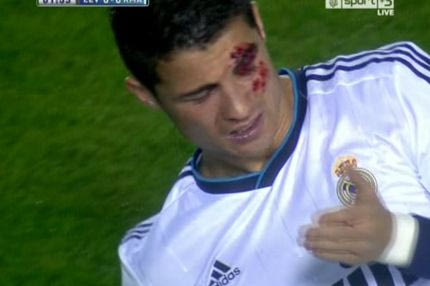 Ο άσχημος τραυματισμός του Ρονάλντο στο μάτι