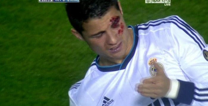 Ο άσχημος τραυματισμός του Ρονάλντο στο μάτι