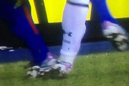 Τραυματισμός σοκ του Μπέιλ