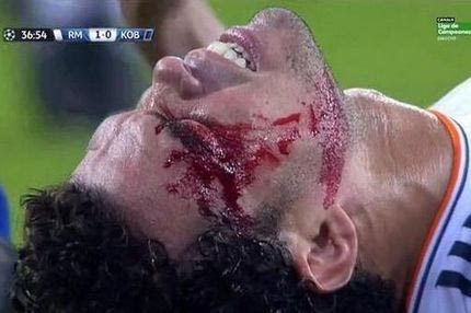 Ο σκληρός τραυματισμός του Πέπε