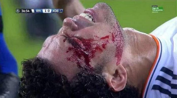 Ο σκληρός τραυματισμός του Πέπε