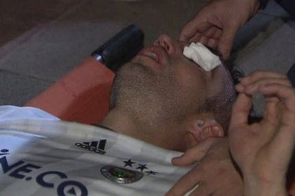 Τρομακτικός τραυματισμός του Φαν Πέρσι στο μάτι